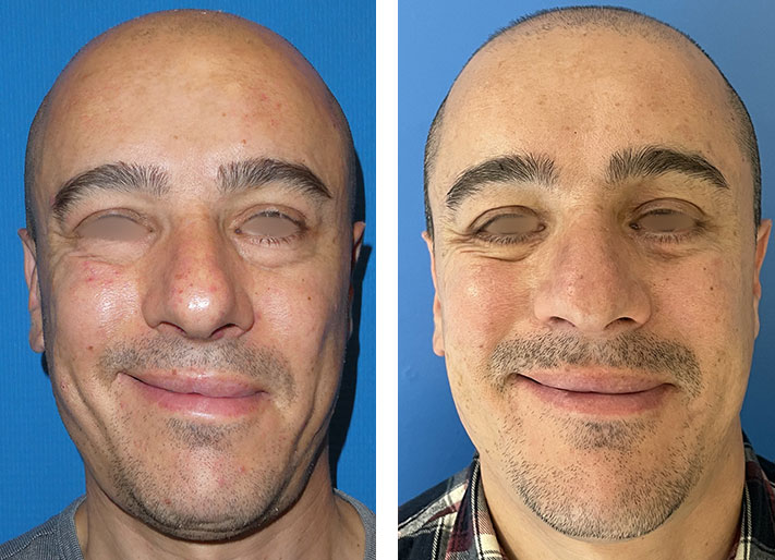 Photos avant/après de paralysie faciale Lyon- Dr Gebert Chirurgie ...
